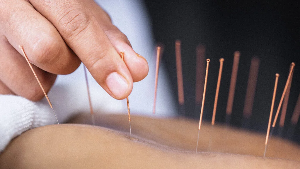 Acupuncture